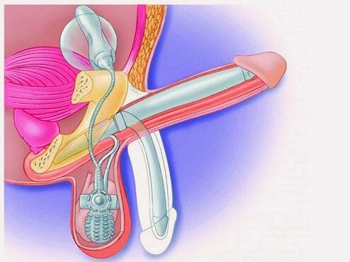 Tăng kích thước dương vật bằng dương vật giả